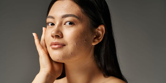Effective Acne Treatment and Prevention: Proven Tips to Clear Your Skin