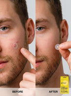 Gle Clean™ Acne Pimple Patches with Hydrocolloid