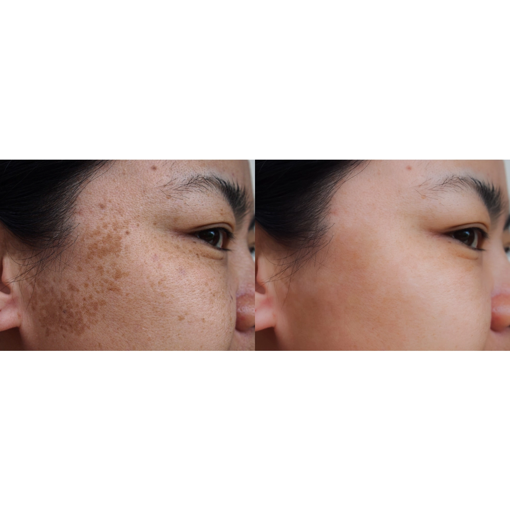 Skin Brightening Facial Serum with Kojic Acid, Vitamin C and Turmeric - [Gle Skincare]